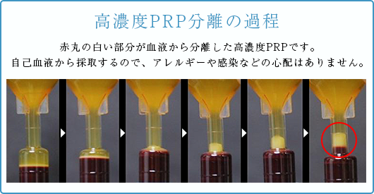 高濃度PRP分離の過程